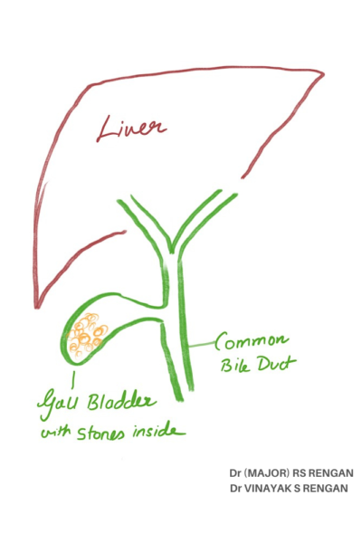 gallbladder with stones inside