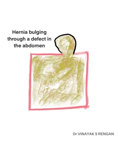 Hernia Bulging defect in the abdomen