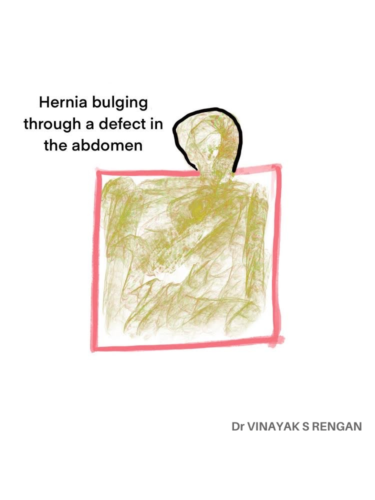 hernia-bulging-defect-in-the-abdomen Hernia Bulging defect in the abdomen