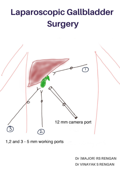 laparoscopic surgical procedure to remove gallbladder