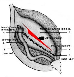 hernia surgery without mesh