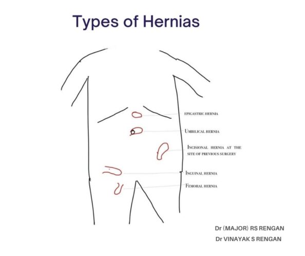 Types of Hernias in Adult