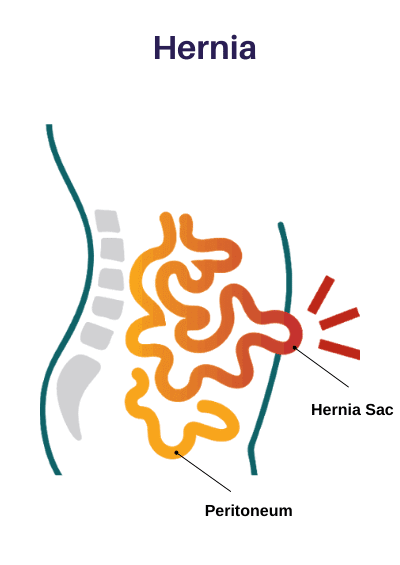 Best hospital for hernia surgery in chennai