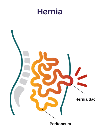 Hernia Treatment & Surgery in Chennai