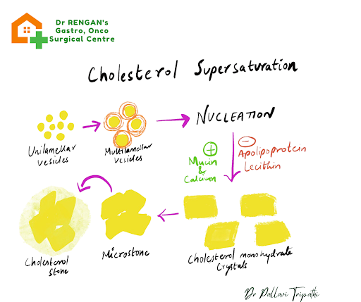 Cholesterol Stones