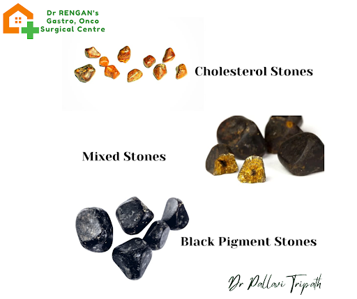 Pigmented Stones